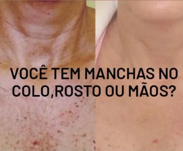 Adena DAY Tratamento de manchas 