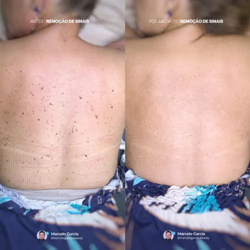 Remoção de Sinais e Verrugas