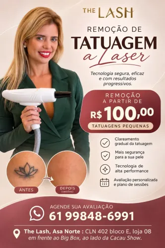 Remoção de tatuagem