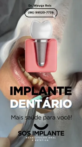 Implante dentário 