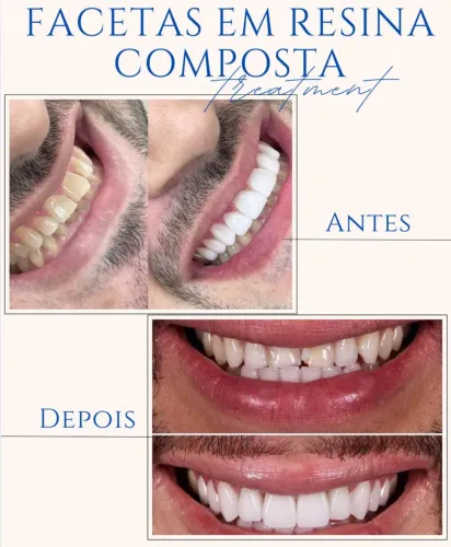 Facetas em Resina R$ 2.499,00