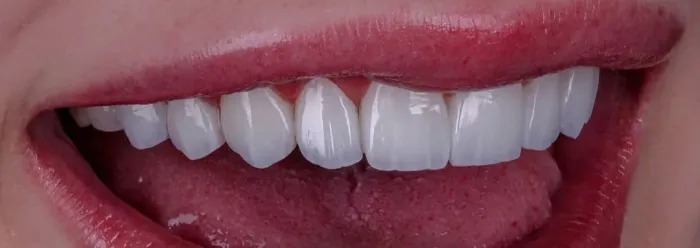 Dentes brancos 97 reais