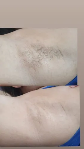 Epilaçao em mulheres ?