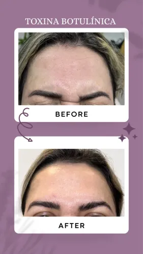 Toxina botulínica (botox)