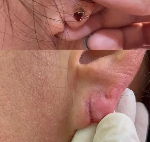 Lobulopastia sem corte