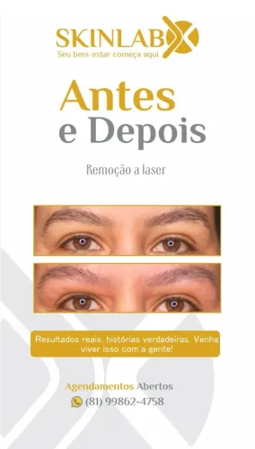 Remoção a laser de micropigmentação de sobrancelhas