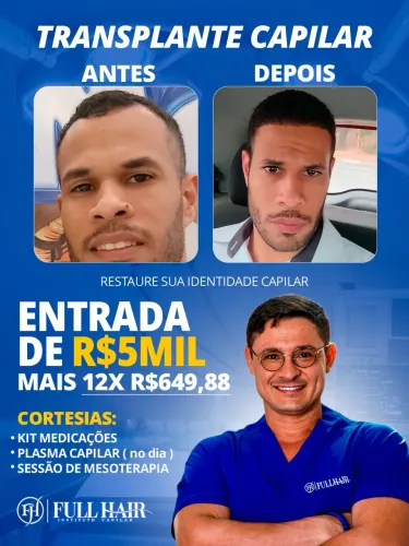 TRANSPLANTE CAPILAR F.U.E