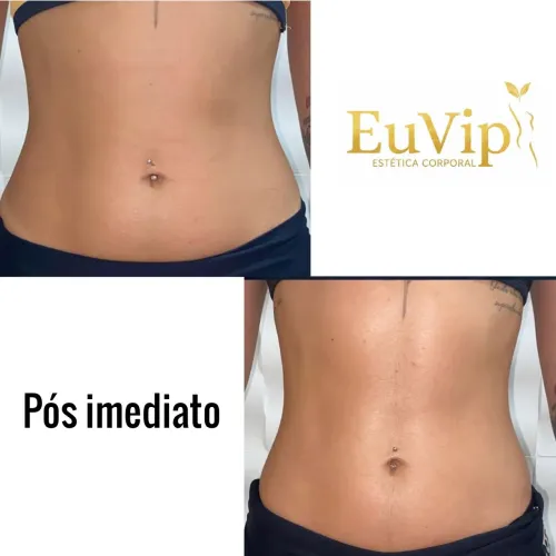 Lipo Cavitação 