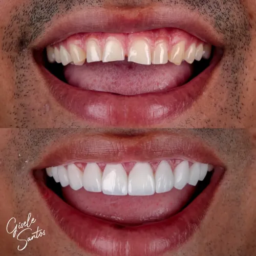 Lente de Resina 10 dentes PROMOÇÃO
