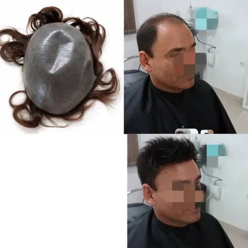 Prótese Capilar preço já incluso a prótese e a colocação