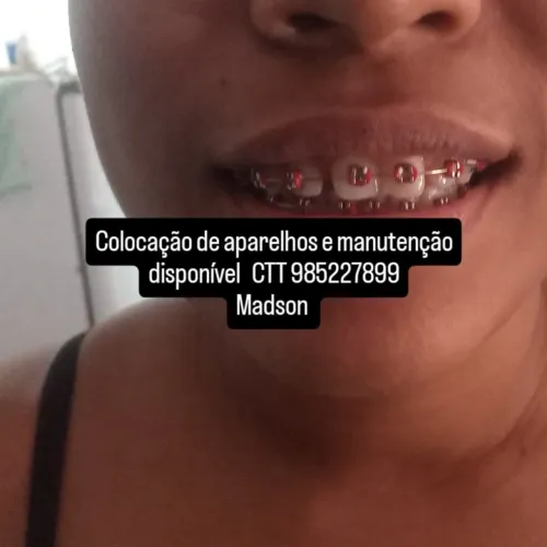 Colocação de aparelho