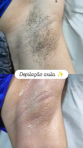 Depilação cera