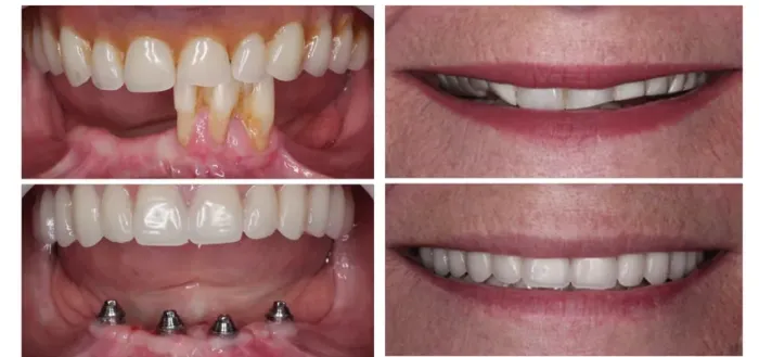 Prótese Dentadura Implantes