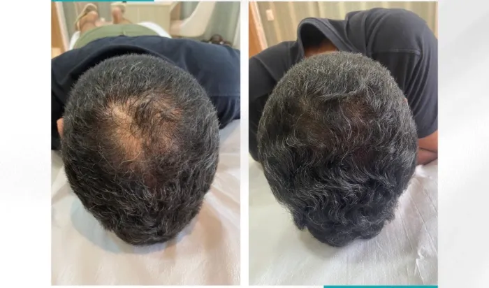 Tratar queda de cabelo