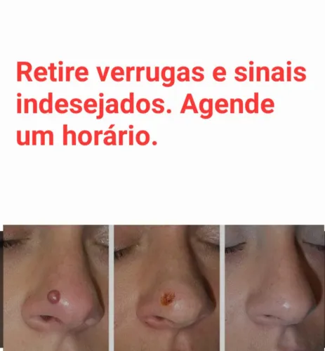 Limpeza de pele bem profunda com e sem cauterização 