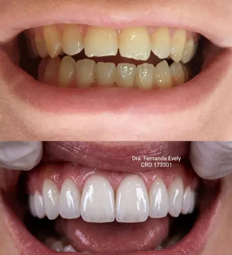 Facetas em resina 1.300 ou até 10x cartão. 