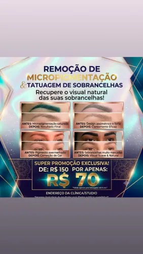Remoção de tatuagem e micropigmentação