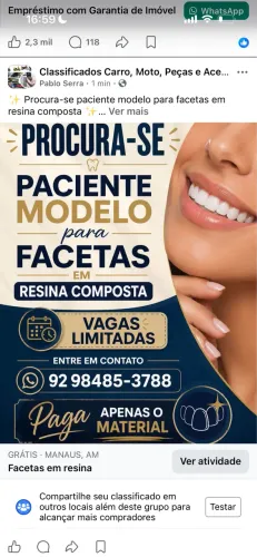 Facetas em resina 
