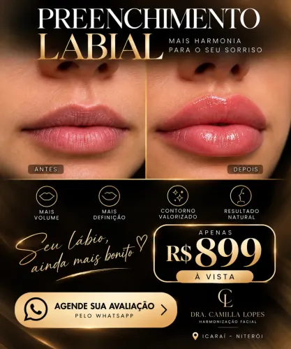 Oferta Preenchimento Labial 