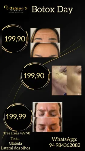 Botox para amenizar rugas 