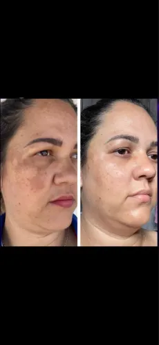 Tratamento para melasma completo e personalizado 