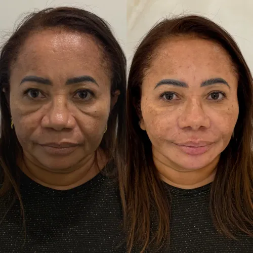 Harmonização facial 30% de desconto