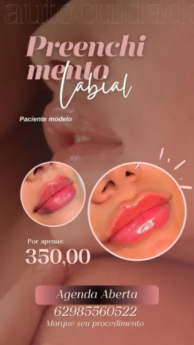 Preenchimento labial 