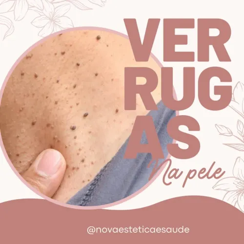 Remoção a laser de pintas e verrugas!!