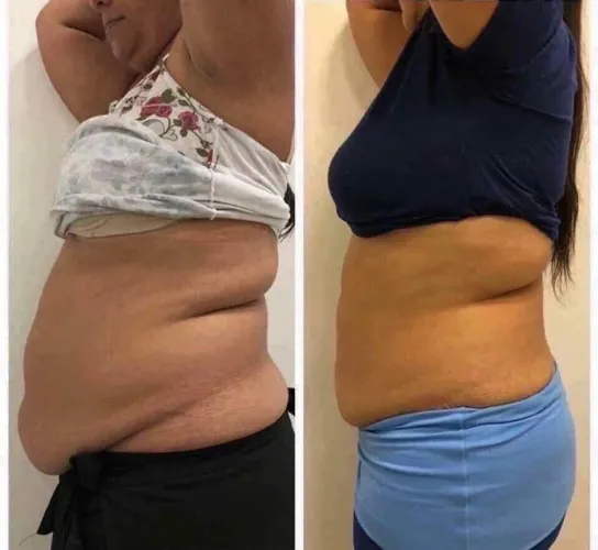 Carboxterapia para gordura localizada 