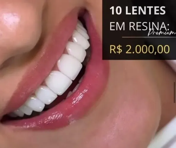 Facetas em resina 