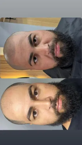 Cobertura de Calvície