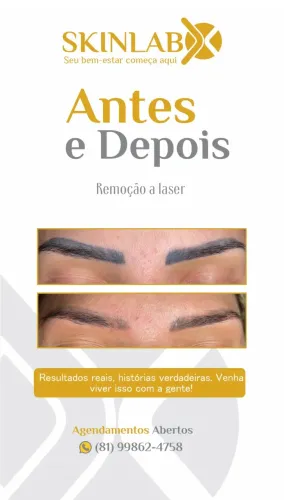 Chegou a hora de remover sua tatuagem 