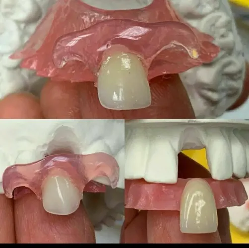 Prótese dentária 
