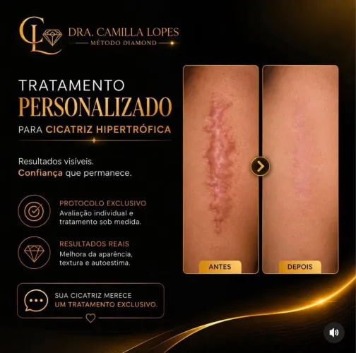 Tratamento personalizado para cicatriz em Icarai