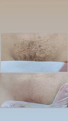 Depilação a cera