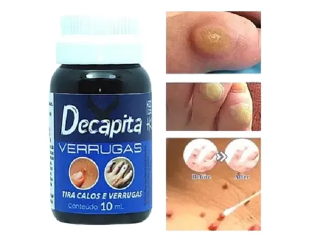 Decapita Removedor de Verrugas Pointss
