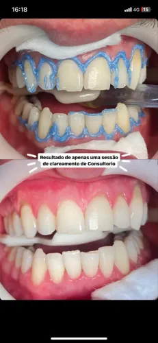 Clareamento 