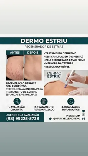 Tratamento definitivo de estrias