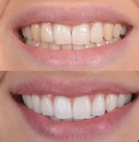 Dentista Clareamento no Consultório
