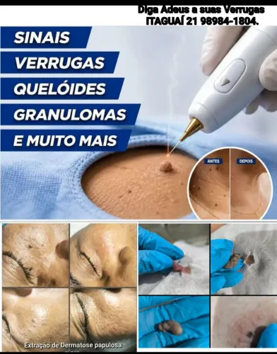 Adeus Verrugas em Itaguaí cuidados com a pele