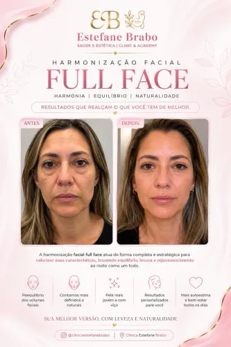 Procedimento harmonização facial!