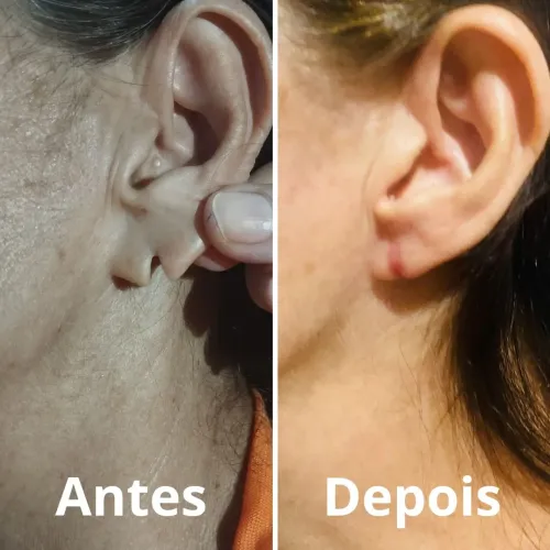 Reconstrução de orelha