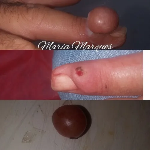 Remoção de verrugas ou queloides