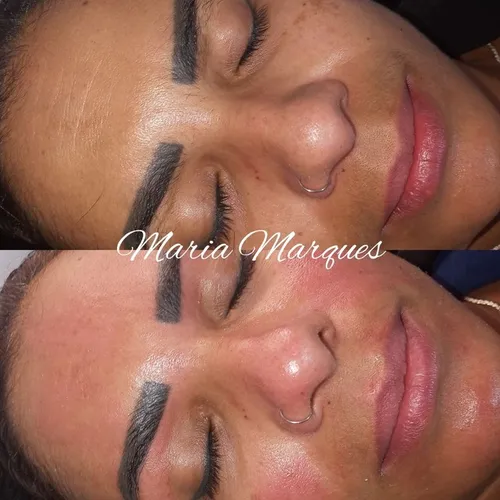 Limpeza de pele com Peeling ultrassonico