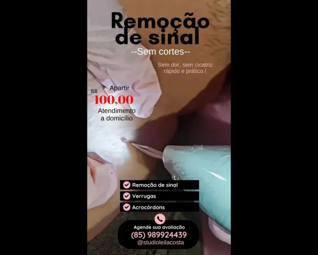 Remoção de sinal