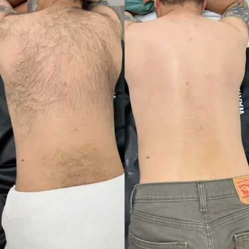Depilação corporal feminina e masculina