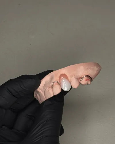 PPR acrílica prótese dentária acrílica 