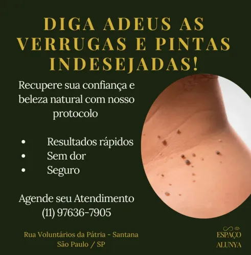 Remoção de Verrugas 