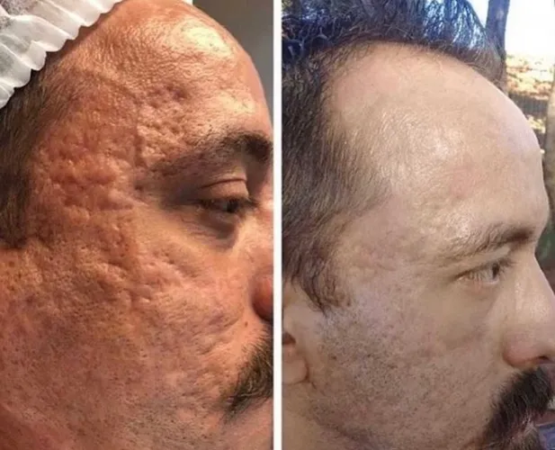 Peeling
