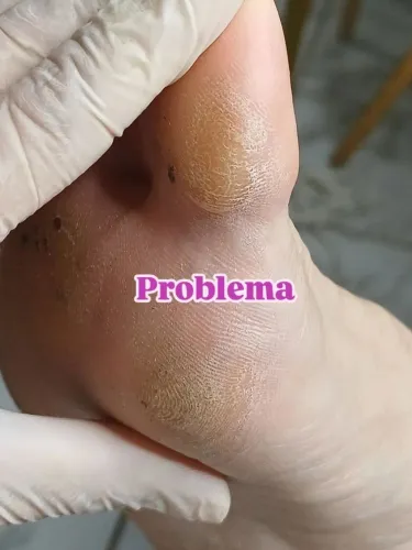Pedicure especializado 